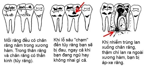 Răng Hàm Bị Sâu Nguyên Nhân, Triệu Chứng Và Cách Điều Trị