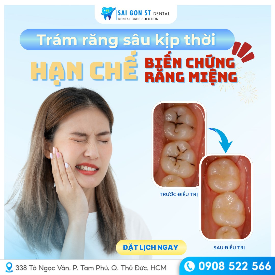Răng Hàm Bị Sâu Nguyên Nhân, Triệu Chứng Và Cách Điều Trị