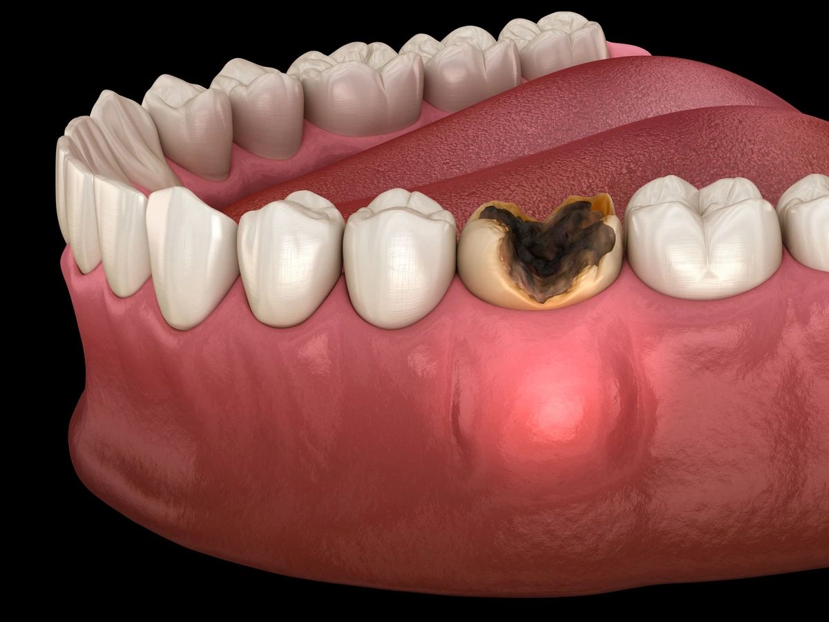 Sâu Răng Là Gì Nguyên Nhân, Triệu Chứng Và Cách Điều Trị (1)