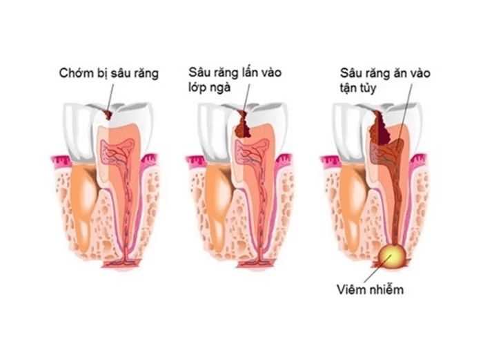 Sâu Răng Là Gì Nguyên Nhân, Triệu Chứng Và Cách Điều Trị (2)