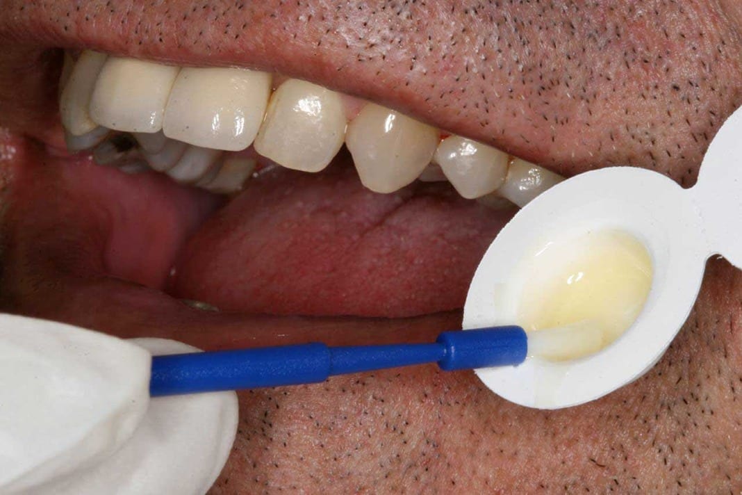 Sâu Răng Là Gì Nguyên Nhân, Triệu Chứng Và Cách Điều Trị (5)