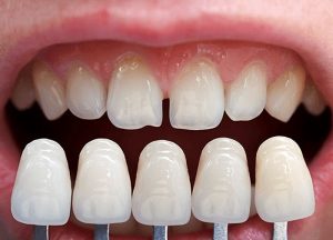 Phủ răng sứ thẩm mỹ là gì? Những ưu nhược điểm của phủ răng sứ