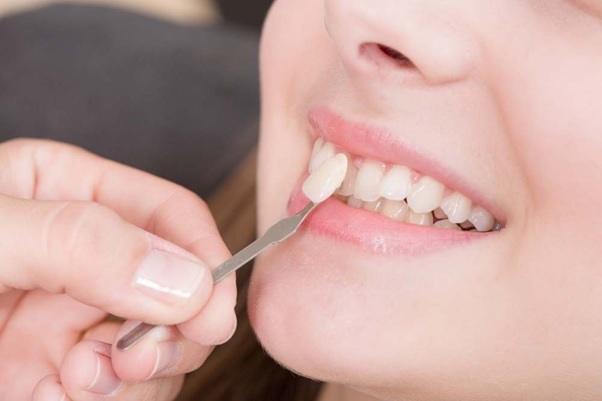 Phủ răng sứ không những tối ưu tính thẩm mỹ mà còn khôi phục khớp cắn, cải thiện khả năng ăn nhai