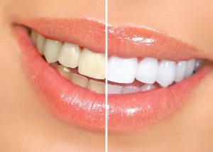 Tẩy trắng răng có an toàn và chất lượng không?