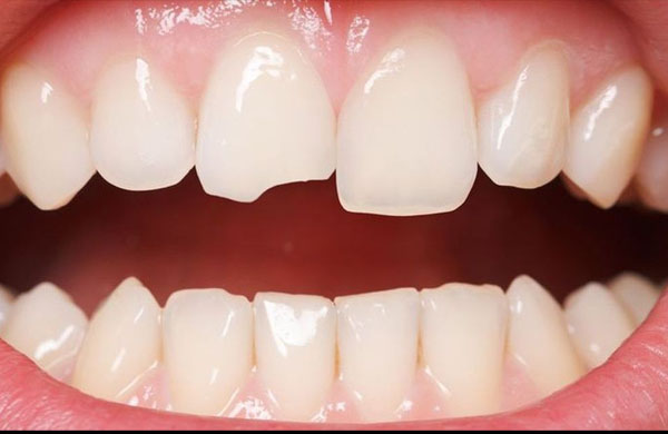 Bị mẻ răng có sao không? Có ảnh hưởng gì không?
