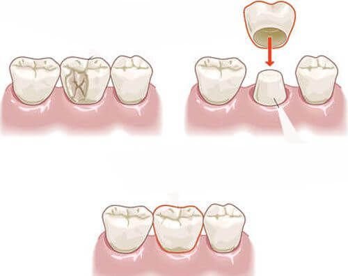 Bọc sứ để khắc phục tình trạng sâu răng, giúp bảo vệ tủy