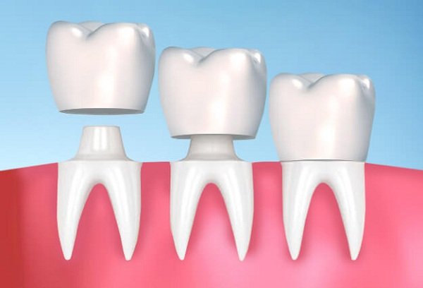 Quá trình bọc răng sứ diễn ra nhanh chóng và an toàn, chỉ cần khoảng 2 - 3 lần hẹn