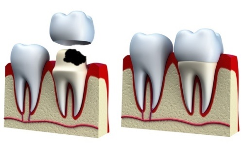 Bọc răng sứ tuy là giải pháp mang đến hàm răng đều đẹp, trắng sáng và thẩm mỹ.