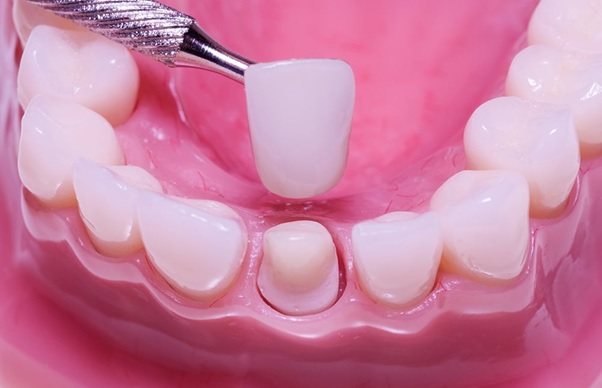 Bọc răng sứ để điều trị răng cửa thưa