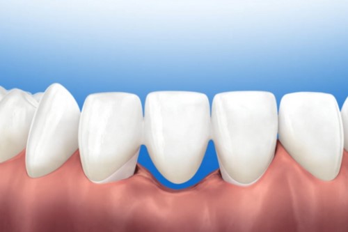 Cầu răng sứ là phương pháp trồng răng cố định
