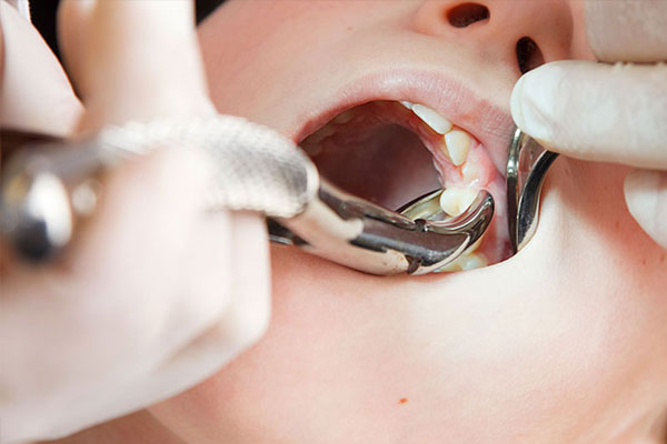 Chăm sóc răng sau khi nhổ