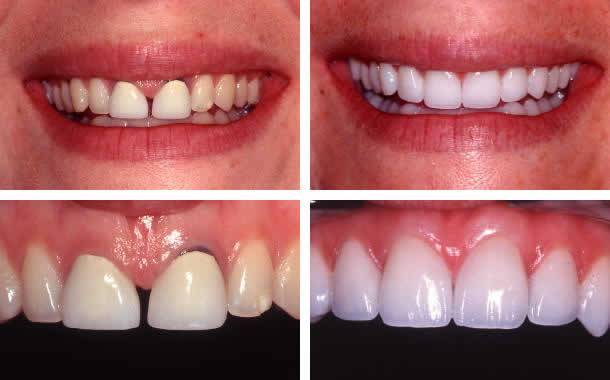 Bọc răng sứ khắc phục tình trạng răng thưa hiệu quả