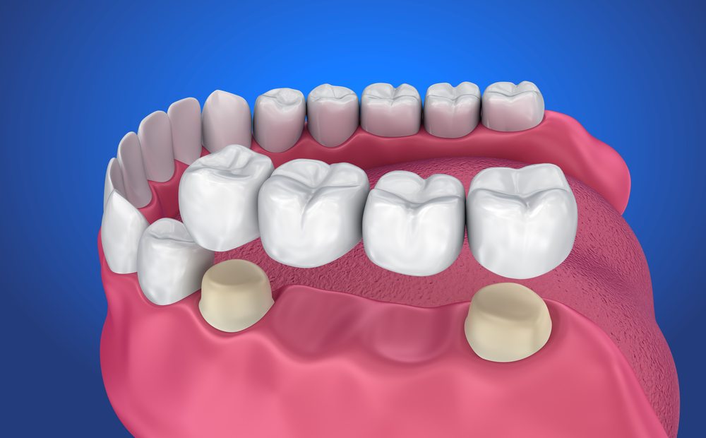 Cầu răng sứ là phương pháp phục hình răng mất giúp đảm bảo khả năng ăn nhai và thẩm mỹ