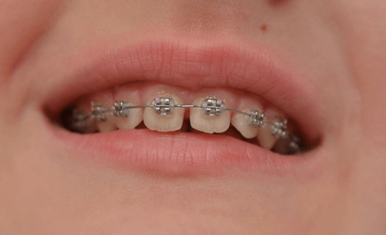 Niềng răng là phương pháp tạo lực kéo, để tác động lên răng, đưa răng về vị trí mong muốn trên cung hàm,