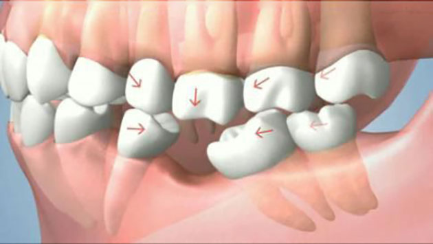 Tác hại của việc mất răng số 6