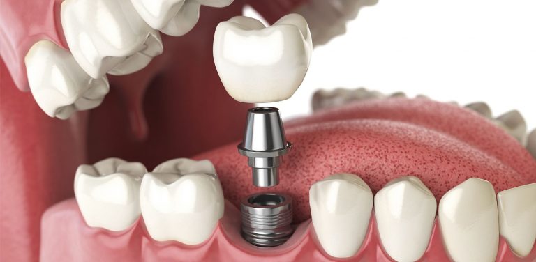 Bạn có thể chọn loại trụ cao cấp để rút ngắn thời gian trồng răng Implant