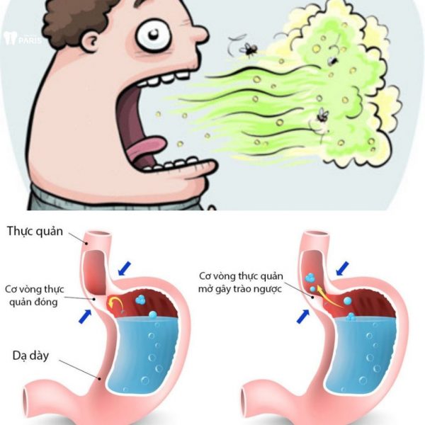 Hôi miệng dạ dày: Nguyên nhân và mẹo chữa “cực nhạy”