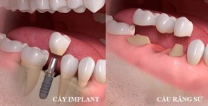 Người mất răng nên làm cầu răng hay Implant?