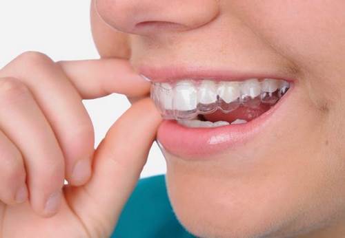Tẩy trắng răng là quá trình làm răng sáng màu