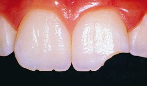 Nguyên nhân, cách xử lý và phòng ngừa răng mẻ