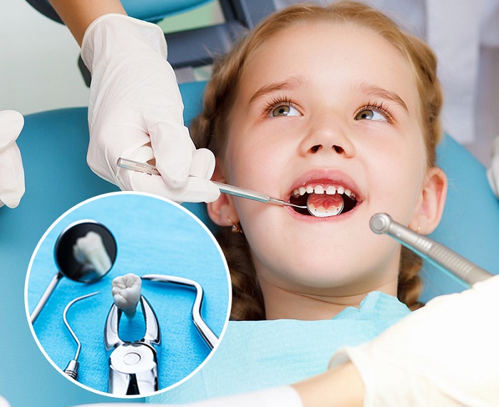 Có nhiều nguyên nhân gây ra tình trạng răng mọc lệch ở trẻ em
