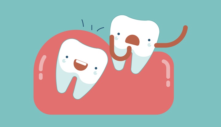 Nếu răng số 8 bị sâu nặng, bác sĩ có thể chỉ định nhổ để tránh gây ảnh hưởng đến các răng xung quanh