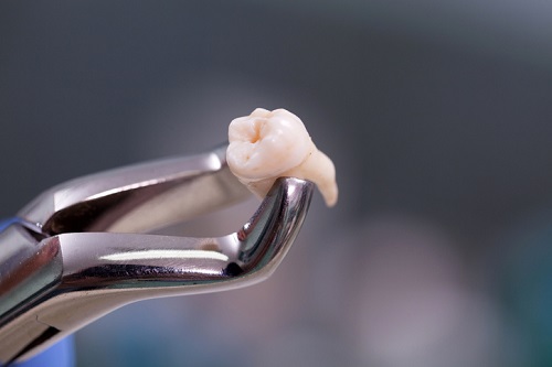 Trước khi nhổ răng số 8, bệnh nhân sẽ được kiểm tra sức khỏe cẩn thận
