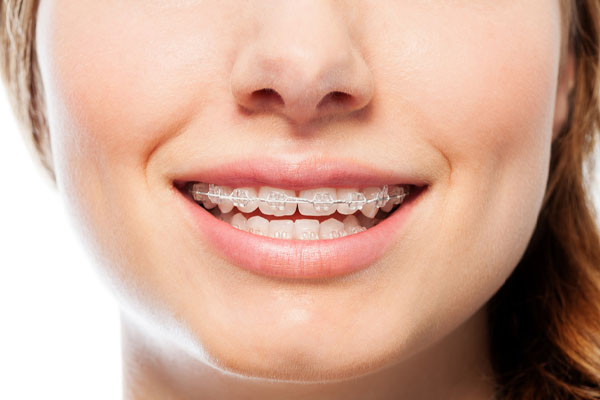 Niềng răng là phương pháp tạo lực kéo, để tác động lên răng, đưa răng về vị trí mong muốn trên cung hàm,
