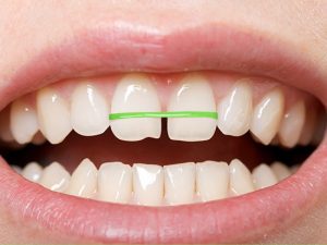 Răng cửa bị thưa phải làm sao và cách khắc phục hiệu quả nhất?