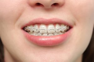 Niềng răng hô là gì? Có bao nhiêu phương pháp niềng răng
