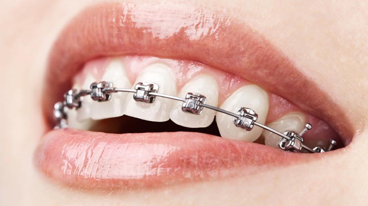 Niềng răng mắc cài - Phương pháp chỉnh nha xuất hiện từ lâu đời