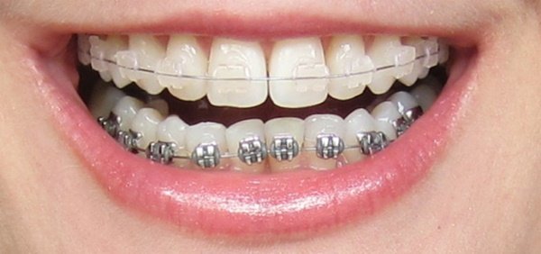 Niềng răng là cách điều trị răng tối ưu, áp dụng cho răng bị hô, móm, vẩu ở mức độ nặng