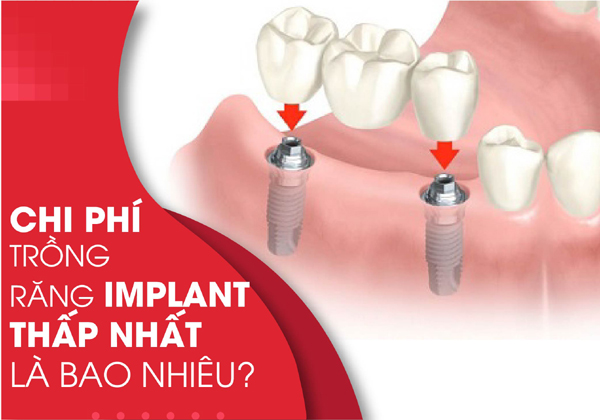 Chi phí trồng răng Implant Hàn Quốc giá bao nhiêu còn tùy thuộc vào từng nha khoa