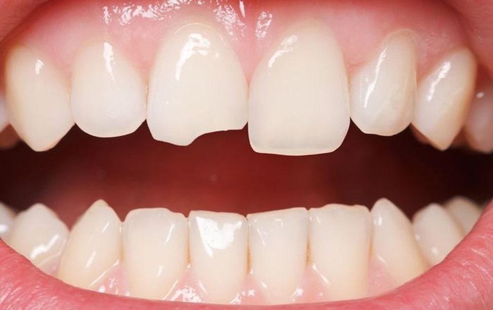 Nếu bị mẻ răng, bạn có thể trám, dán sứ hoặc bọc sứ