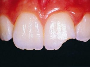 Nguyên nhân, cách xử lý và phòng ngừa răng bị mẻ
