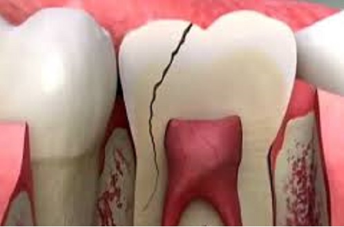 Mẻ răng hàm là gì? Nguyên nhân và tác hại khi mẻ răng hàm?