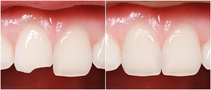 Có thể trám để hồi phục răng bị mẻ