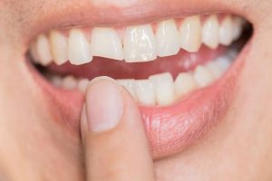 Răng cửa bị mẻ – nên trám hay bọc sứ?