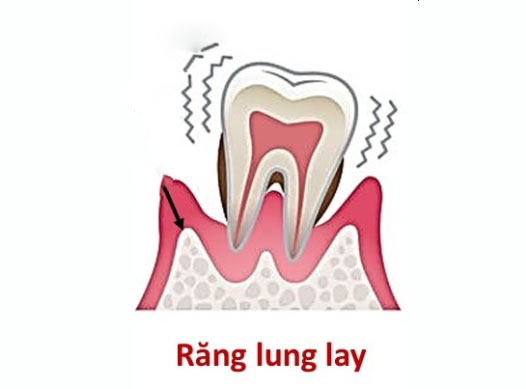Có nhiều nguyên nhân khiến răng Implant bị lung lay