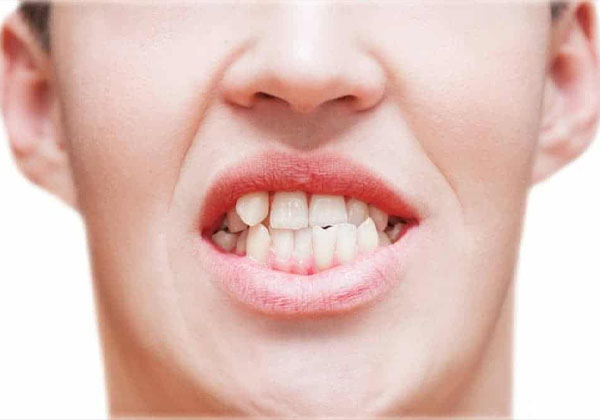 Răng lệch lạc là do một bệnh lý về khớp cắn