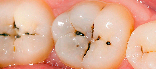 Răng hàm sâu nặng là gì? răng sâu nặng phải làm sao?