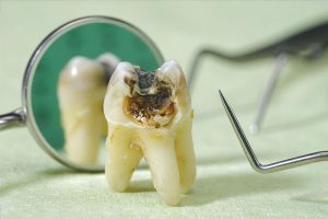 Răng sâu có nên nhổ không? Răng sâu không nhổ có sao không?