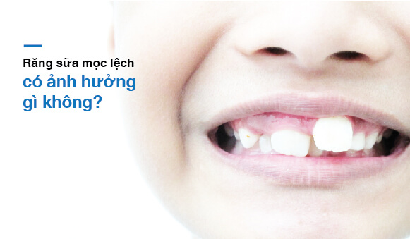 Răng mọc lệch vào trong làm sai lệch khớp cắn, các răng trên cung hàm không thể đồng bộ với nhau