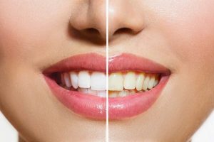 Răng vàng ố phải làm sao? Cách trị răng vàng ố như thế nào?