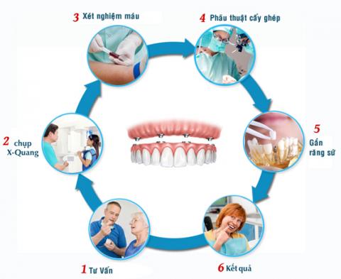 Quy trình trồng răng Implant 