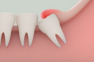 Sâu răng số 8 phải làm sao? Nên điều trị hay nhổ bỏ tốt hơn?