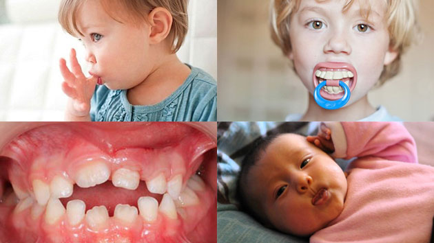Hạn chế tình trạng răng mọc lệch bằng cách nào?