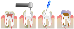 Răng sâu vào tủy – Dấu hiệu nhận biết và cách chữa trị hiệu quả!