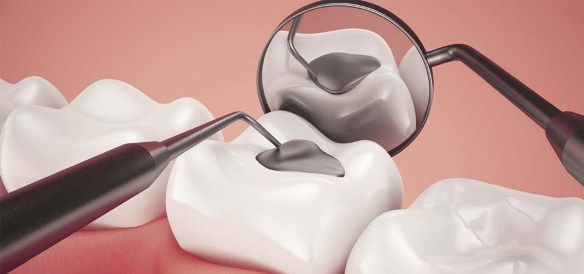 Trám răng - Phương pháp điều trị răng sâu hiệu quả