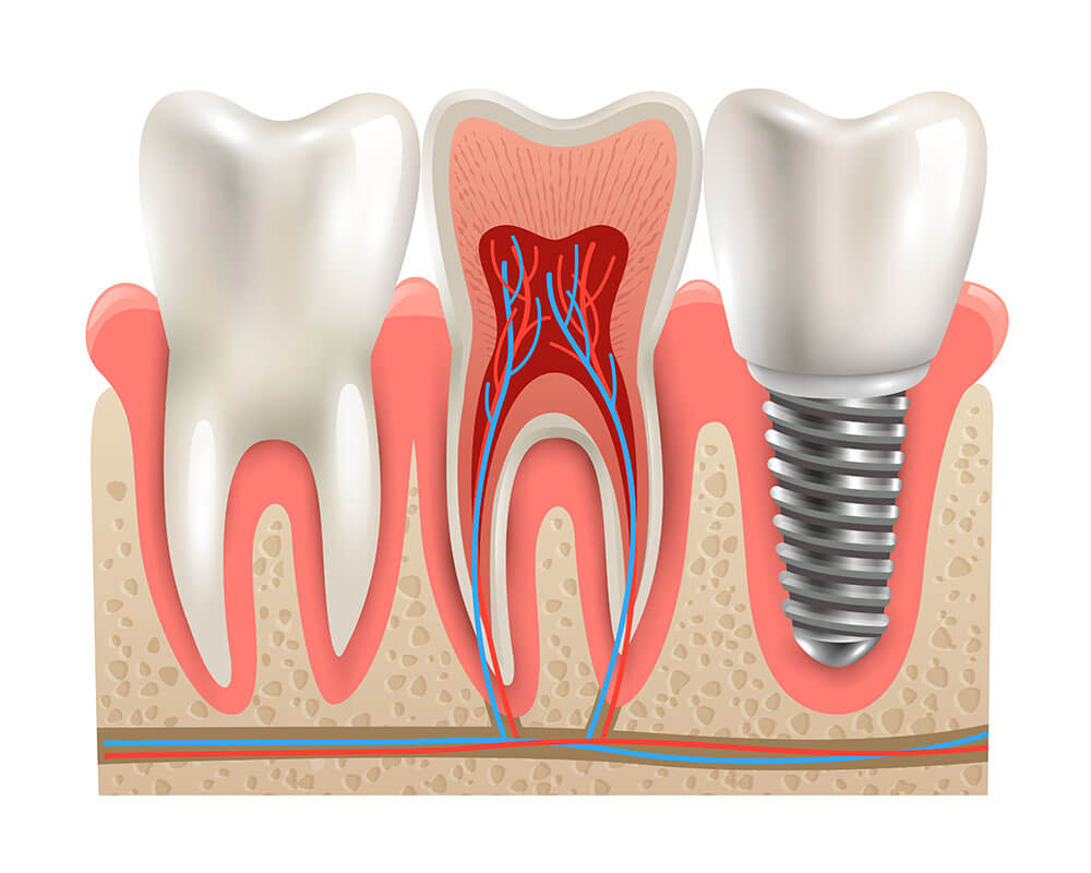 Răng Implant có thể duy trì vĩnh viễn nếu được chăm sóc tốt